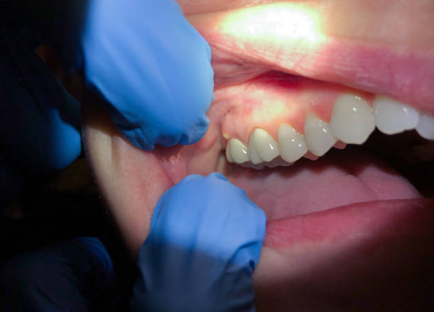 Best Emergency Broken Tooth Repair in Singac, NJ