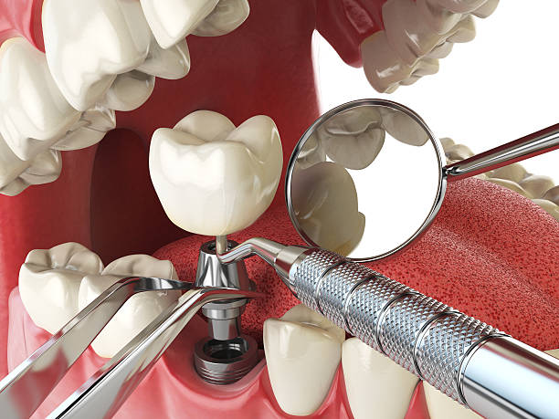 Best Emergency Tooth Extraction in Singac, NJ